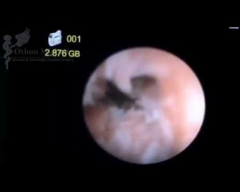 Ενδοσκοπική αντιμετώπιση κύστης κόκκυγα (EpSiT) και RF